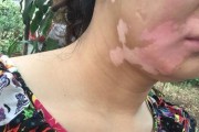 激光投影仪出现黑点问题的原因与解决方法（探索激光投影仪黑点问题的根源和解决方案）