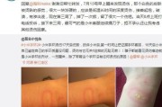 运动手环使用中出现烫伤怎么办？