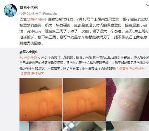 运动手环使用中出现烫伤怎么办？